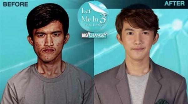 خضع لعملية تجميل.. فلم تتعرف أمه عليه