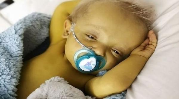 رضيع يتحول جلده إلى لون أصفر في حالة نادرة