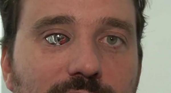 بعد فقدان إحدى عينيه .. يحولها إلى كاميرا فيديو بهدف تصوير فيديوهاته الخاصة