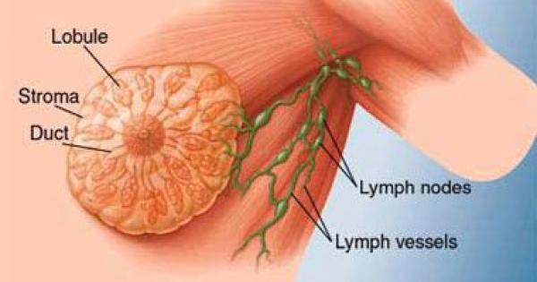 أطباء فرنسيون يتحفظون على التشخيص المبكر لسرطان الثدى