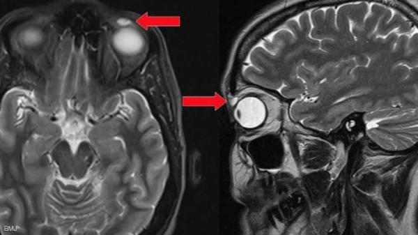 عاشت 30 عاما بشيء غير مريح في عينها.. ثم جاءت "الصدمة"