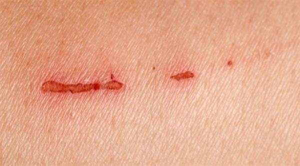 هذه الفيتامينات تساعد على تسريع شفاء الجروح