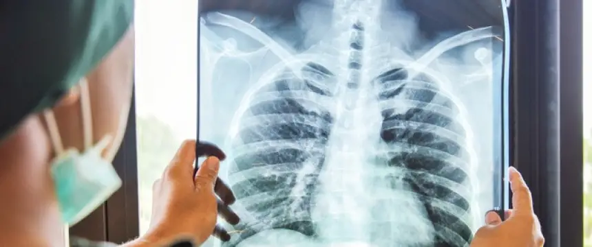 دواء جديد يغيّر مستقبل علاج داء السل ويقلّص مدة الشفاء إلى أشهر أقل