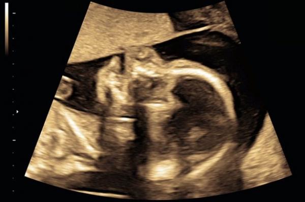 أطباء بريطانيون يتمكنون من استئصال ورم من رئة طفلة لا تزال في رحم والدتها