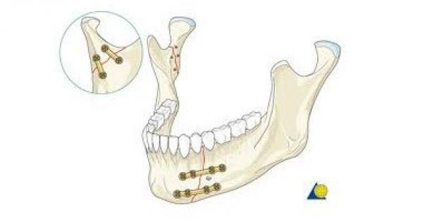 أسباب كسور الوجه والفكين تتمثل فى حوادث السيارات