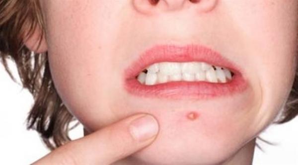 3 أسلحة طبيعية لمحاربة البثور