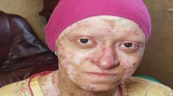 حالة صحية نادرة : امرأة تصاب تفكك البشرة كل صباح