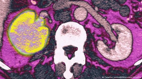 اكتشاف الجينات المرتبطة بأشرس أنواع سرطان الكلى