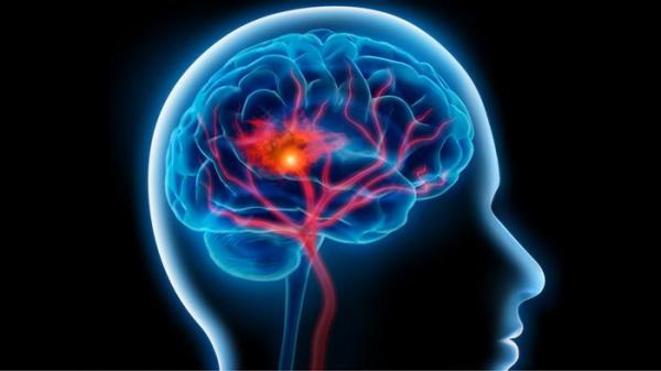 السكتة الدماغية .. أعراضها وطرق علاجها