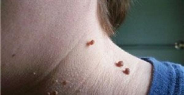 وصفة طبيعية تخلصك من الزوائد الجلدية بالجسم