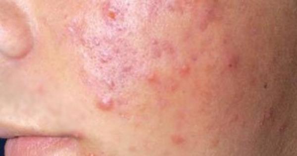 كيف يمكن علاج البثور السوداء بالبشرة؟