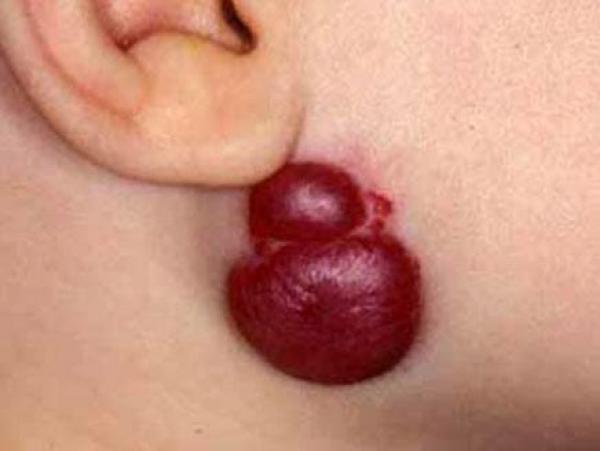 الوحمة.. من لمسة جمال إلى خطر محتمل على صحة الطفل