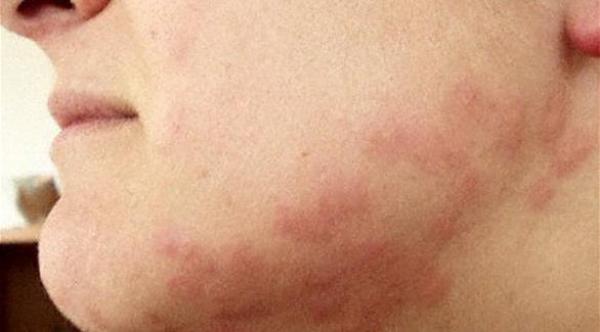 الأرتيكاريا... تُحيل حياة المرضى إلى جحيم