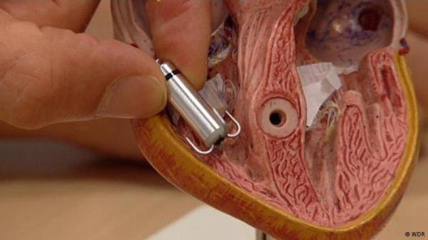 الكبسولة القلبية.. ثورة لأطباء القلب والمرضى