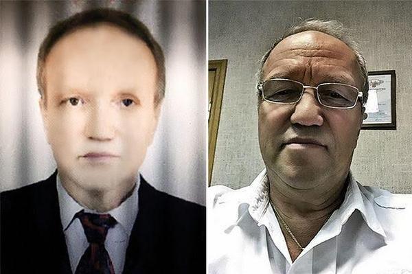 بالصورة.. بعد زراعة كبد من رجل إفريقي روسي يتحول للون الأسود