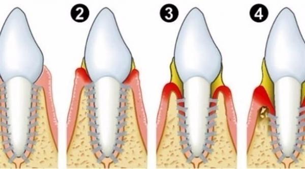 دراسة: أمراض اللثة علامة مبكرة على السكري