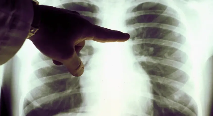 سرطان الرئة يهدد غير المدخنين أكثر.. دراسة تكشف سببا مقلقا