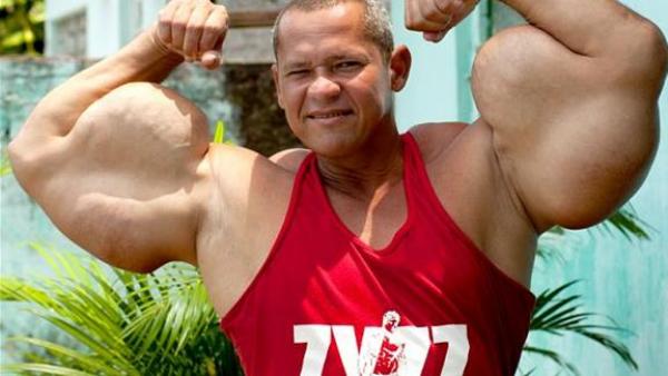 بالصور .. يحقن ذراعه بكوكتيل مؤلف من مواد مميتة  للحصول على عضلات ضخمة