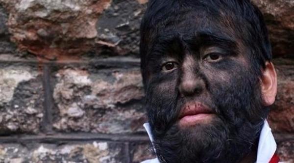 "الرجل الذئب" و"الرجل الشجرة"...أمراض نادرة ولكنها حقيقة