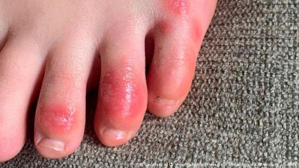 دراسة تكشف سر "أصابع كوفيد"