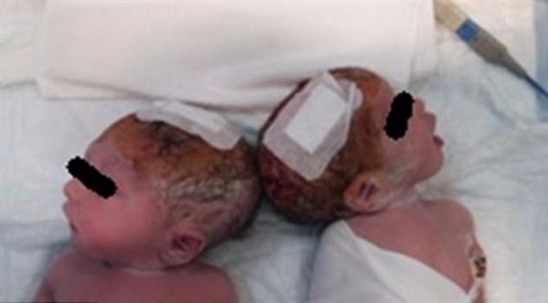 عملية لفصل توأمين ملتصقتين في 30 دقيقة فقط!