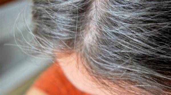 ما سبب الشيب المبكر وكيف يمكن علاجه؟