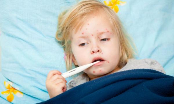 عدد مرضى الحصبة في أوكرانيا أكثر مما هو مسجل في قارة أوروبا مجتمعة