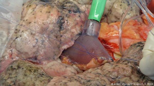 جهاز جديد يجدد الرئة ويحافظ عليها خارج الجسم