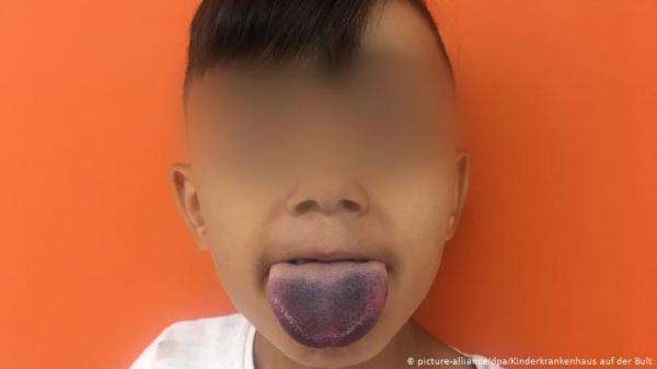 بخدعة ذكية.. طبيبان يحرران لسان طفل عالق في زجاجة