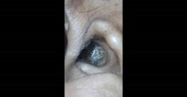 بالفيديو.. عنكبوت يعيش في أذن سيدة يصيبها بالصداع