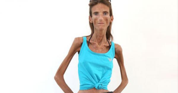 بالصور.. فاليرا لافتين.. أنحف امرأة بالعالم