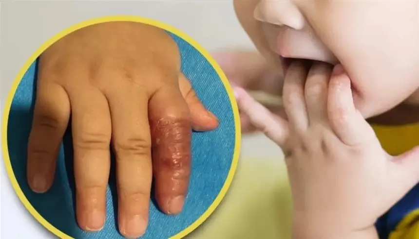 أم صينية كادت تتسبب ببتر إصبع رضيعتها بعد اتباع نصيحة من الإنترنت