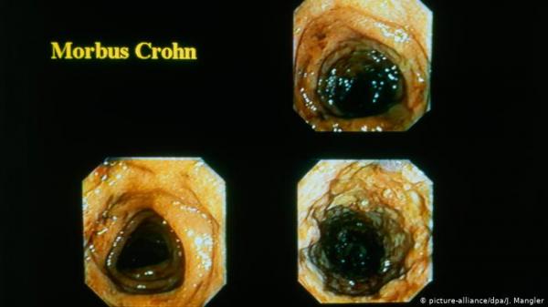 ما الذي يجعل مرض "كرون" غادراً؟