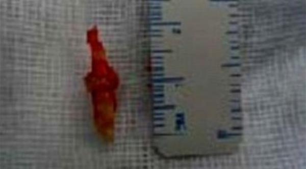 سن ينمو داخل أنف شاب سعودي