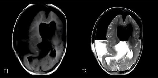 حالة نادرة: جنين ينمو داخل جمجمة طفلة