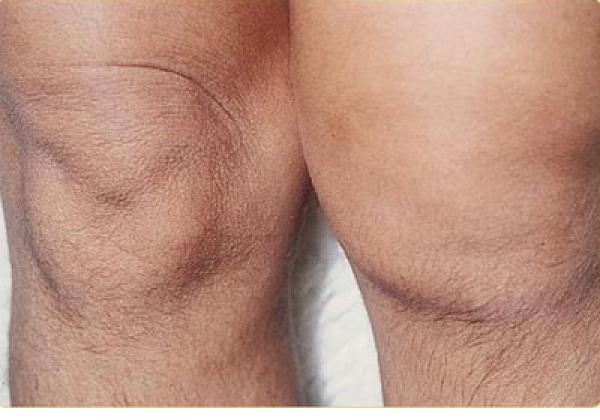 ممارسة الرياضة والتدخل الطبى المبكر يخففان من إلتهاب المفاصل