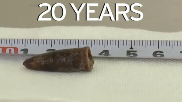 بالفيديو: أطباء يخرجون غطاء قلم بقي في رئة شاب 20 عاماً