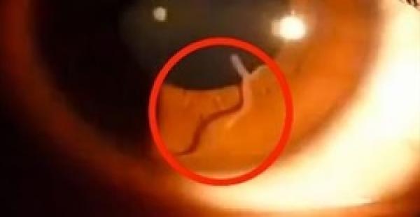 بالفيديو.. لحظة عثور طبيب على «دودة» حية في عين امرأة