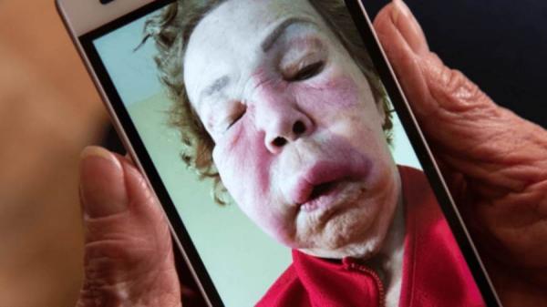 عمليات تجميل غريبة تجتاح المكسيك وتسبب تشوهات للسيدات