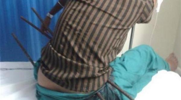 فتاة تخترق جسدها 3 قضبان حديدية و تبقى على قيد الحياة