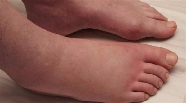 تورم اليدين والقدمين.. على ما يدل؟