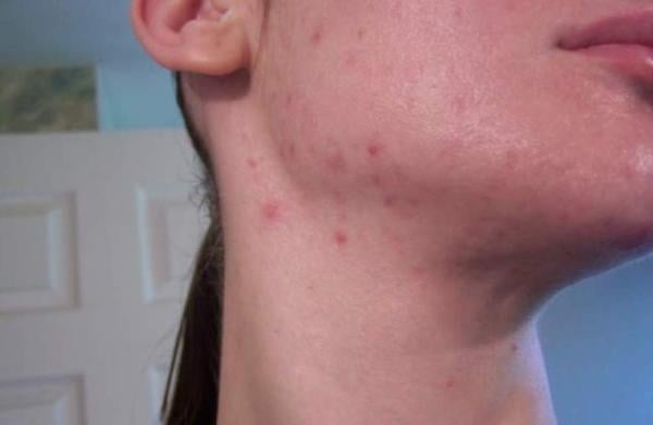 ما هي أهم طرق علاج حب الشباب في العنق ؟