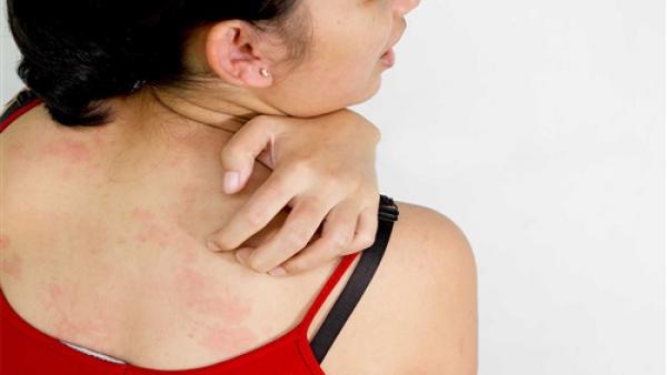 6 خطوات تساعدك في القضاء على حبوب الظهر