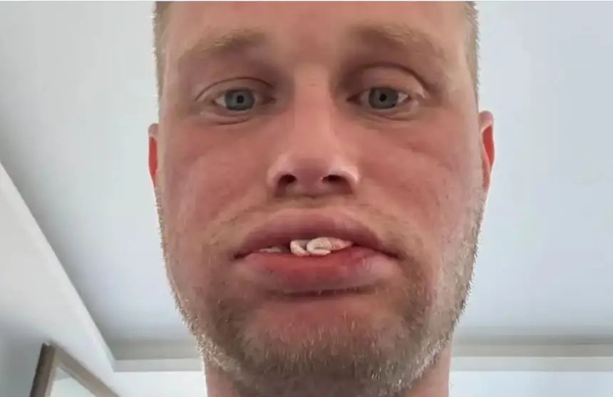 بريطاني سافر إلى تركيا لتجميل أسنانه لكنه فقدها كلها  !