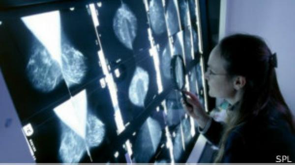 دراسة: الكوليسترول "يغذي" سرطان الثدي