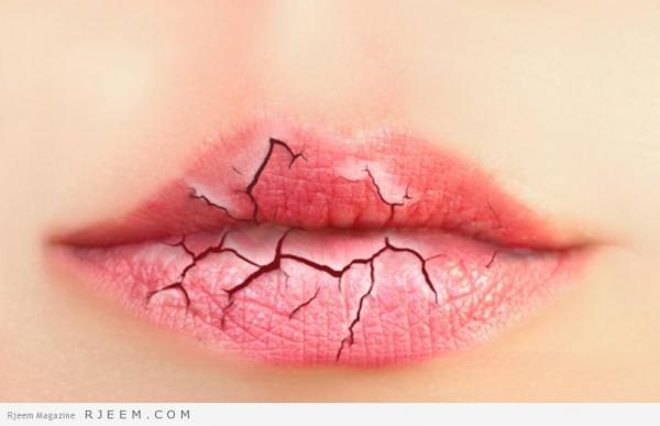 جفاف الشفاه سببه نقص هذا الفيتامين