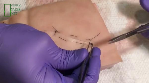 تقنية طبية تبشر بنهاية "الغرز" في العمليات الجراحية