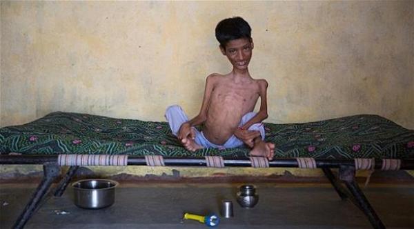 فتى يرى العالم بالاتجاه الصحيح للمرة الأولى بعد عملية جراحية