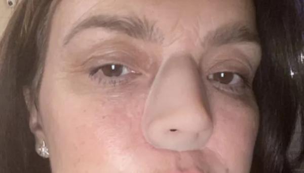 تعيش بأنف اصطناعي بعد جدعه بسبب السرطان