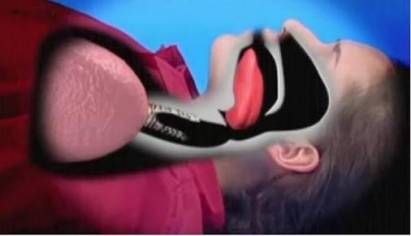 بالفيديو.. كيف تنقذ شخص في حالة بلع لسانه؟